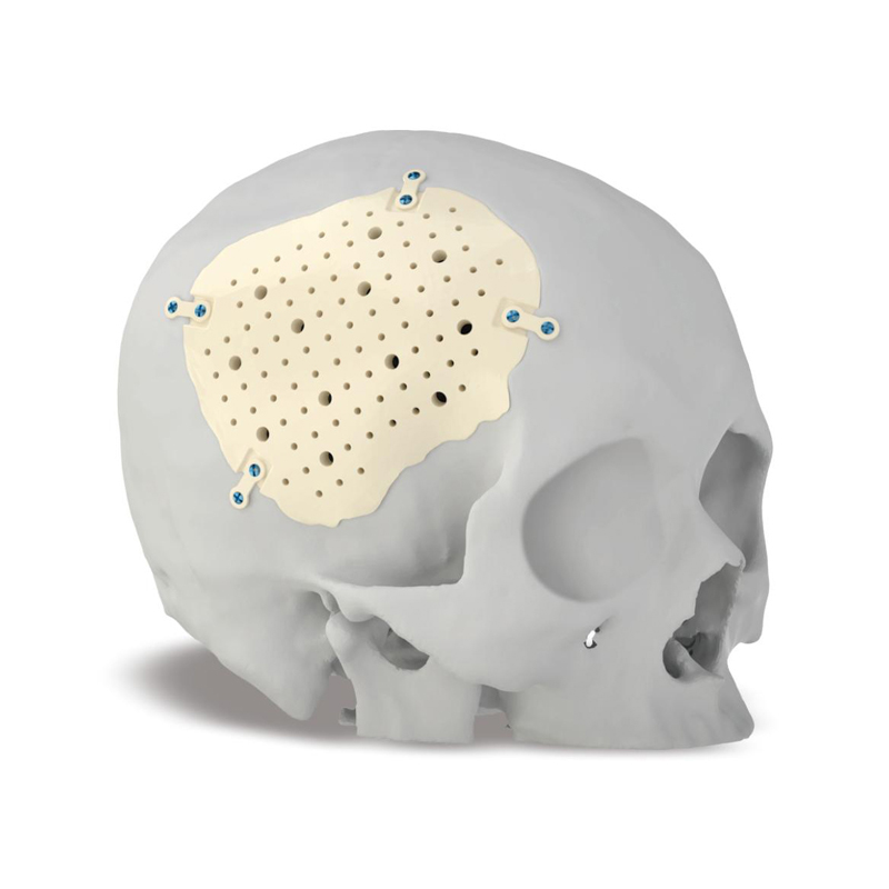 PEEK顱骨修復(fù)體